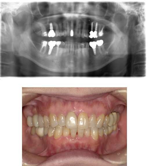 インプラント①after