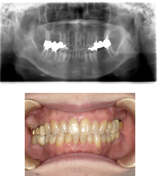 インプラント①before