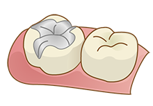 銀歯