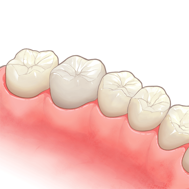 奥歯には「銀歯」「セラミック」どちらがおすすめ？