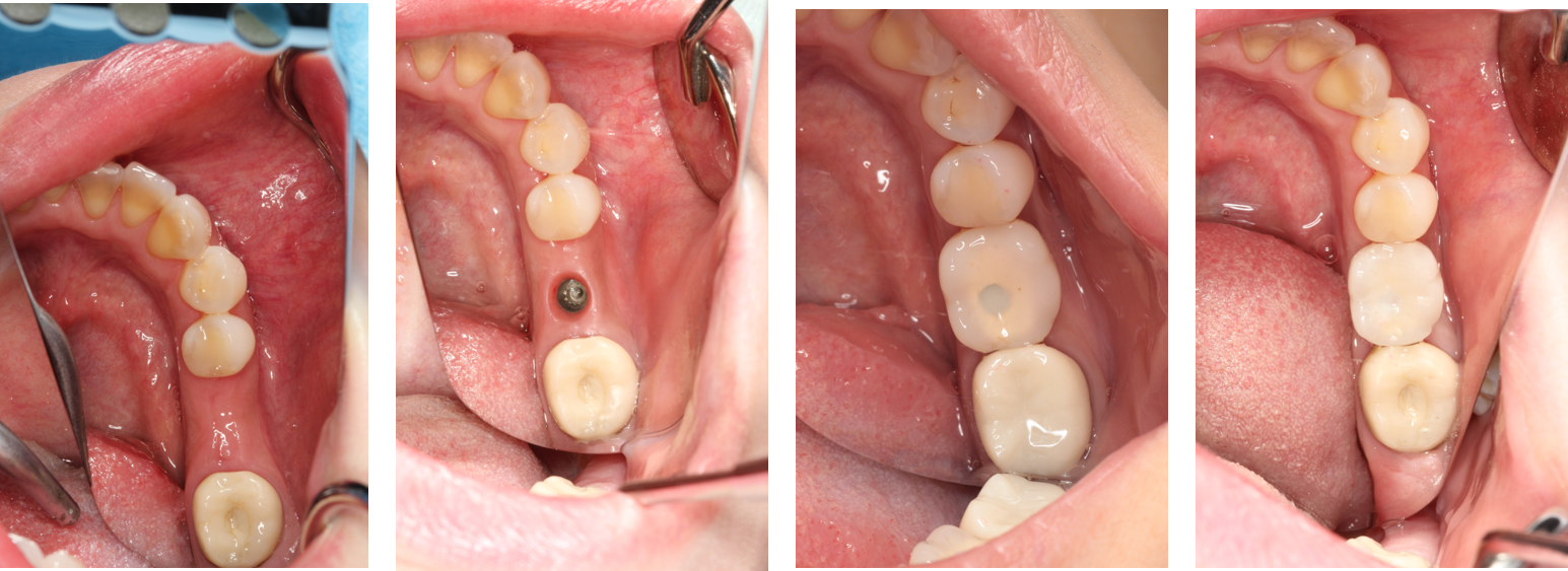 インプラント症例