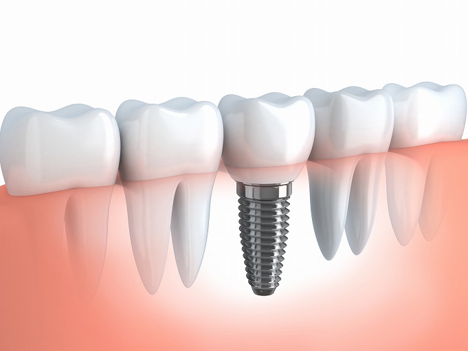 失った歯を補う「インプラント」治療とは