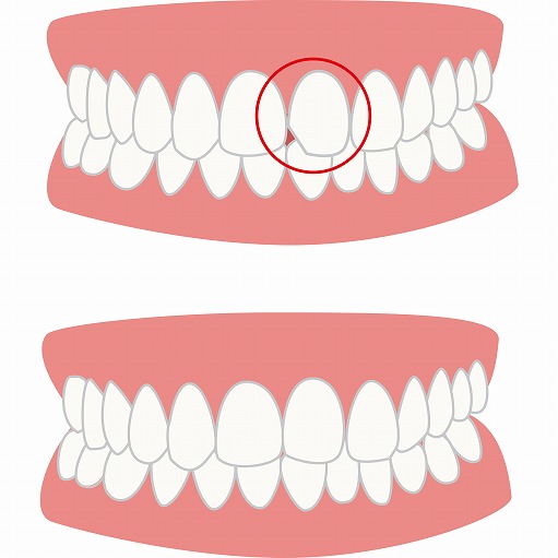歯が欠けた