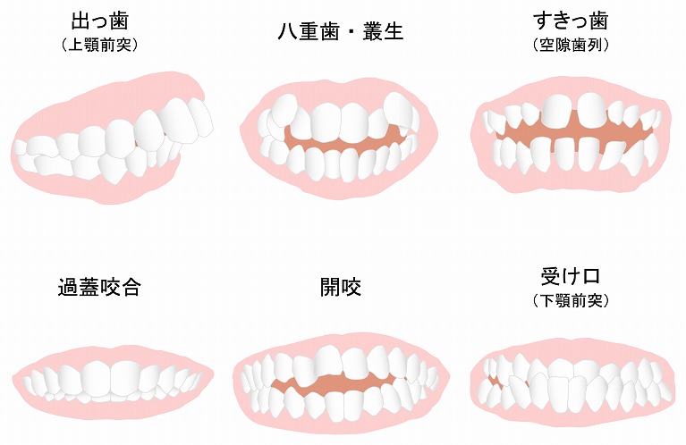 矯正歯科治療をした方がいい？治療できる「悪い歯並び」の種類や例