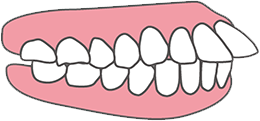 口ゴボの原因は「出っ歯」や「受け口」