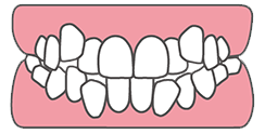 ガチャ歯（叢生、乱ぐい歯）