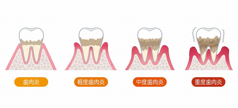 歯周病とは？わかりやすく解説