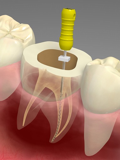 歯の根の治療「根管治療」とは？わかりやすく解説