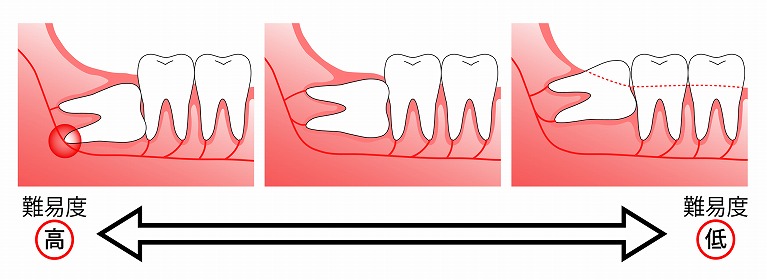 親知らずが痛むときは受診を―難抜歯にも対応致します